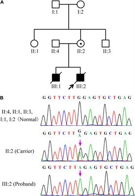 Preimplantation Genetic Testing for a Chinese Family With X-Linked Lymphoproliferative Syndrome Type 1